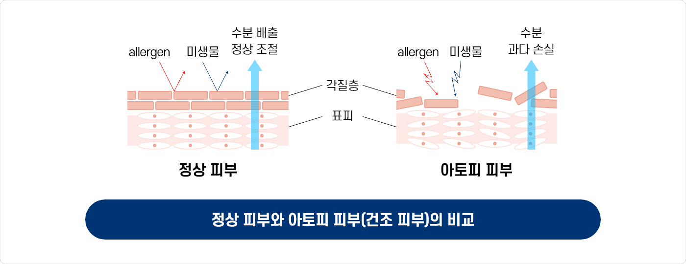함소아한의원 아토피·태열 상세