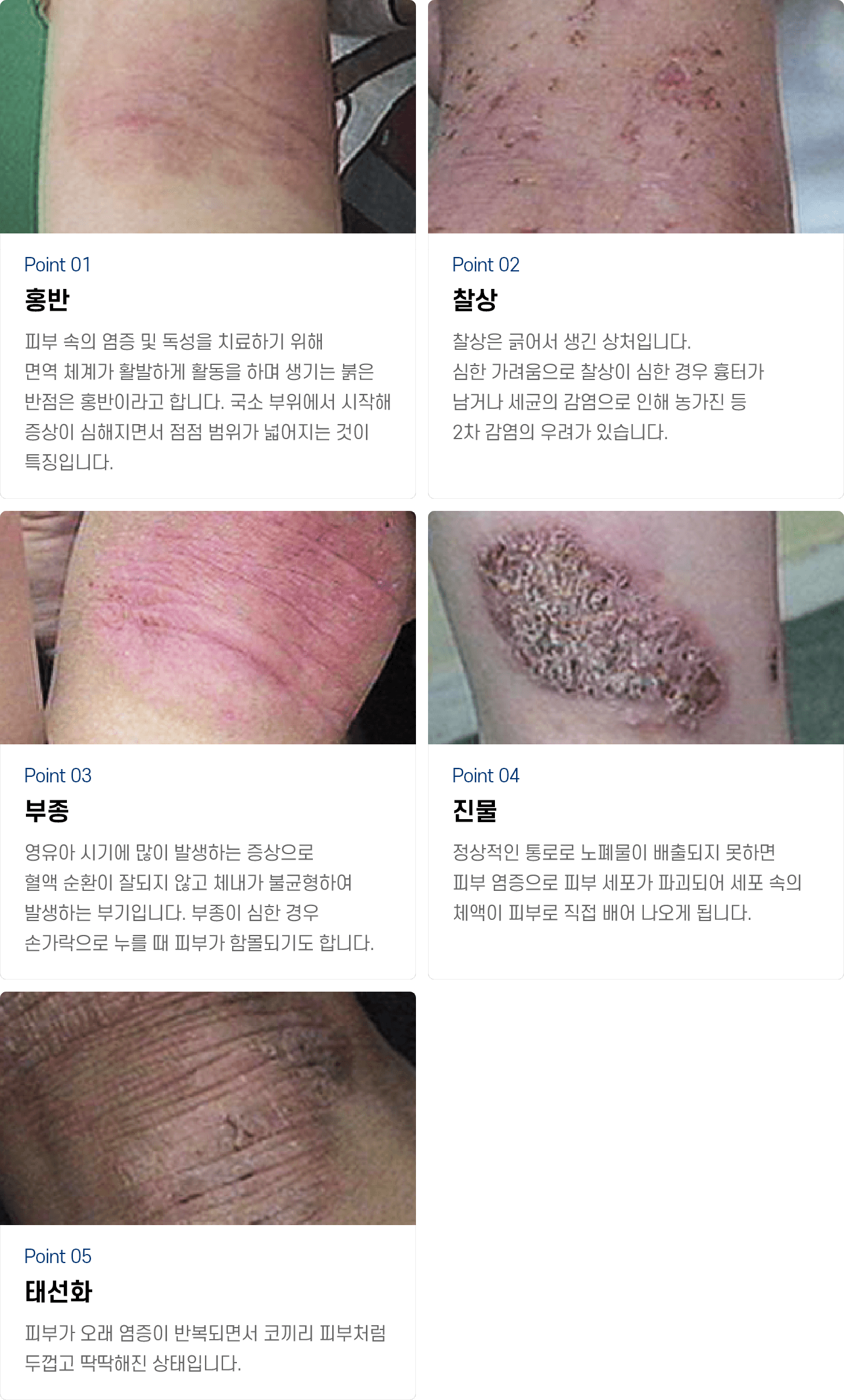 아토피·태열 아이콘